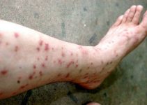 Sand Flea Bites on Humans Symptoms and Treatment