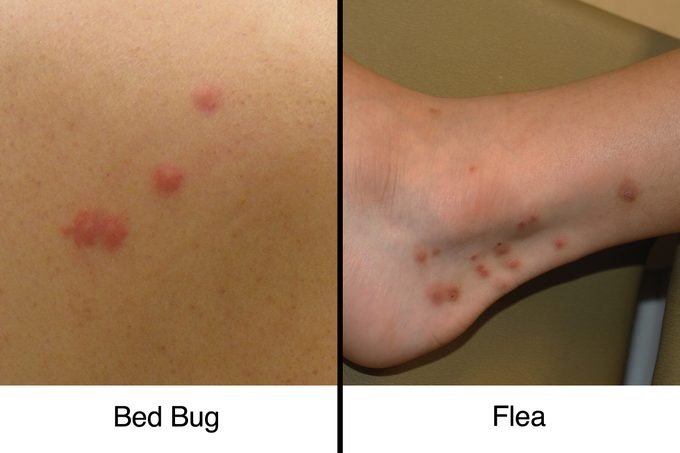 flea bites vs bed bug bites
